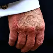 Trump's Discolored Hand Sparks Health Concerns Before Medical Exam