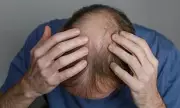 UK Drug Watchdog Warns of Serious Side Effects from Hair-Loss Drugs
