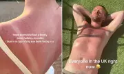 UK Heatwave Sparks Sunburn Warnings as Melanoma Cases Hit Record High