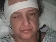 Woman Told to Take Paracetamol by NHS 111 Later Found Comatose with Meningitis