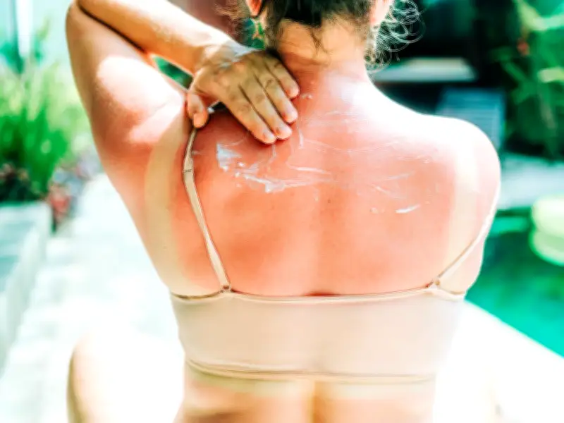 1 in 5 Brits Believe Sunburn Necessary for Tan, Bupa Study Finds