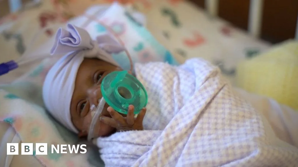 13lb Miracle Baby Battles Health Challenges In Uk Hospital