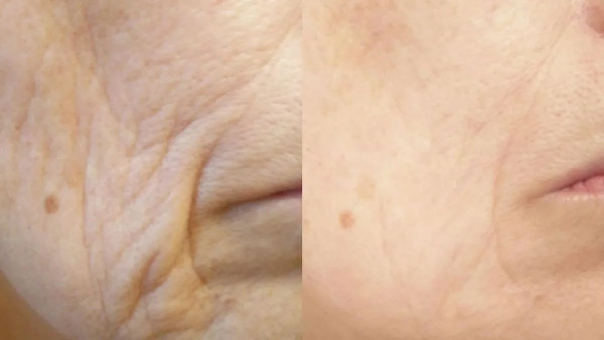 90p-a-Day Collagen Supplement Praised by Shopper Who Says It 'Mimics Botox'