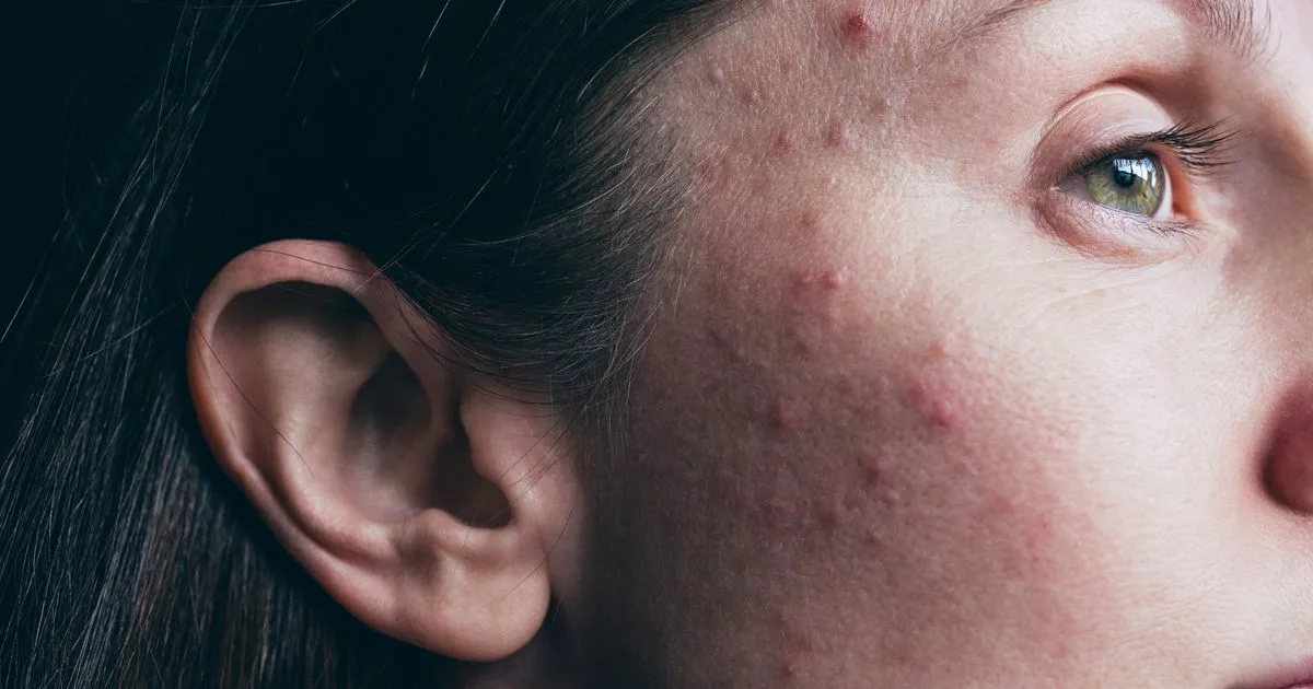 Acne Drug Spironolactone: NHS Warns Against Five Foods