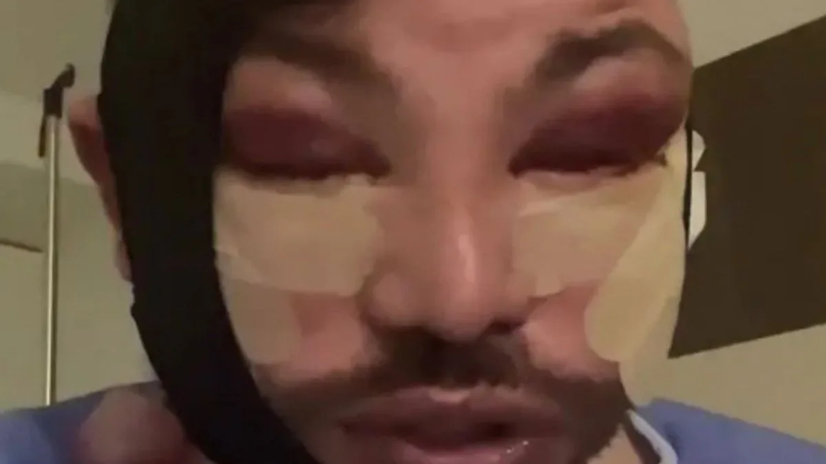 TOWIE Star Bobby Norris Shows Bruised Face After Face and Neck Lift Surgery