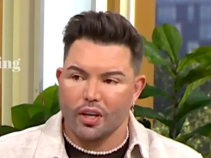 Bobby Norris Spent £50K on Fillers Before Facelift, Wants Gemma Collins Reunion