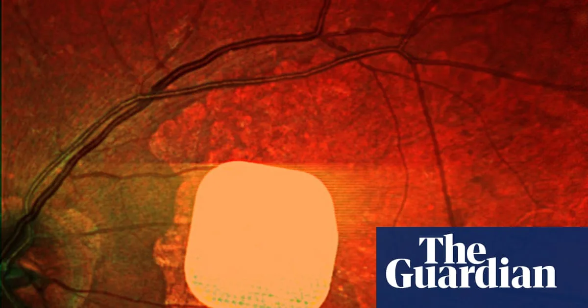 Brain Implant Restores Sight To Blind In UK Breakthrough