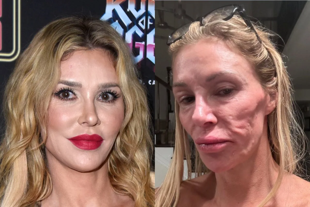Brandi Glanville Receives Diagnosis After Facial Disfigurement