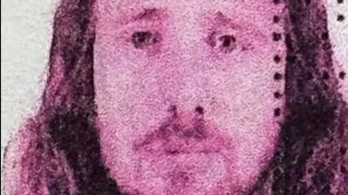 Brit Dies After Turkey Teeth and Hair Transplant
