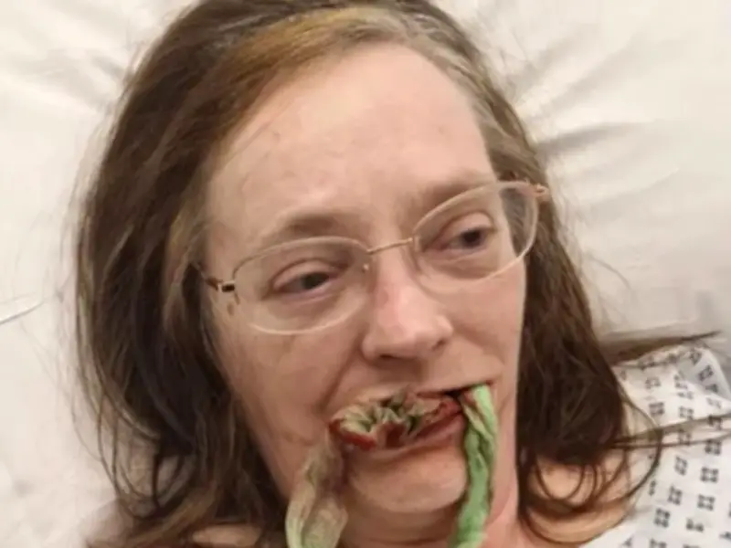 Cancer treatment rots teeth, patient faces £25k implant bill