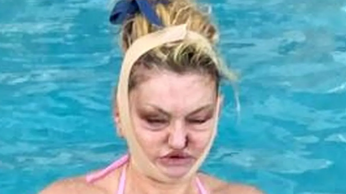 Danniella Westbrook Recovers From Facial Surgery In Dubai