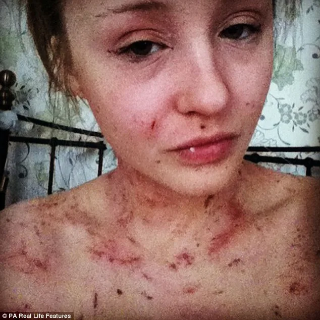 Porridge Oats Transform Woman's Severe Eczema