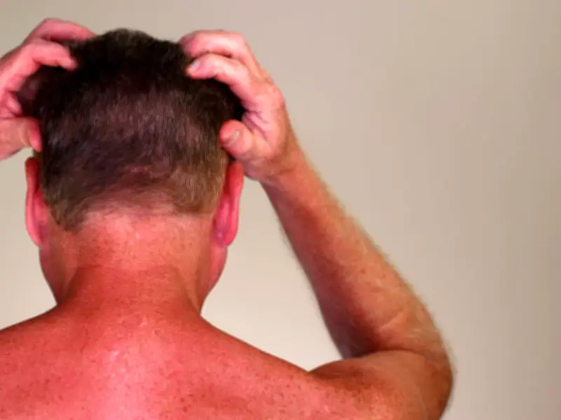 Dermatologist Warns of Sunburn Risk on Overlooked Scalp Area