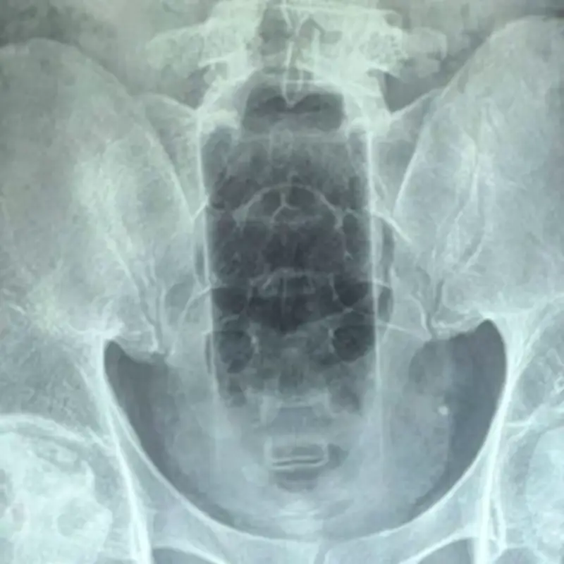Doctors remove 20cm bottle from man's rectum after cleaning mishap
