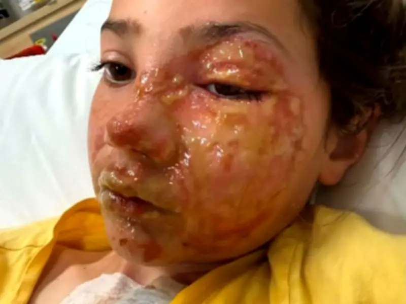 Doctor's Urgent Warning After Girl, 10, Burned by Viral Toy Trend