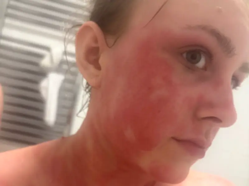 Eczema cream left woman with bleeding skin covering 95% of body