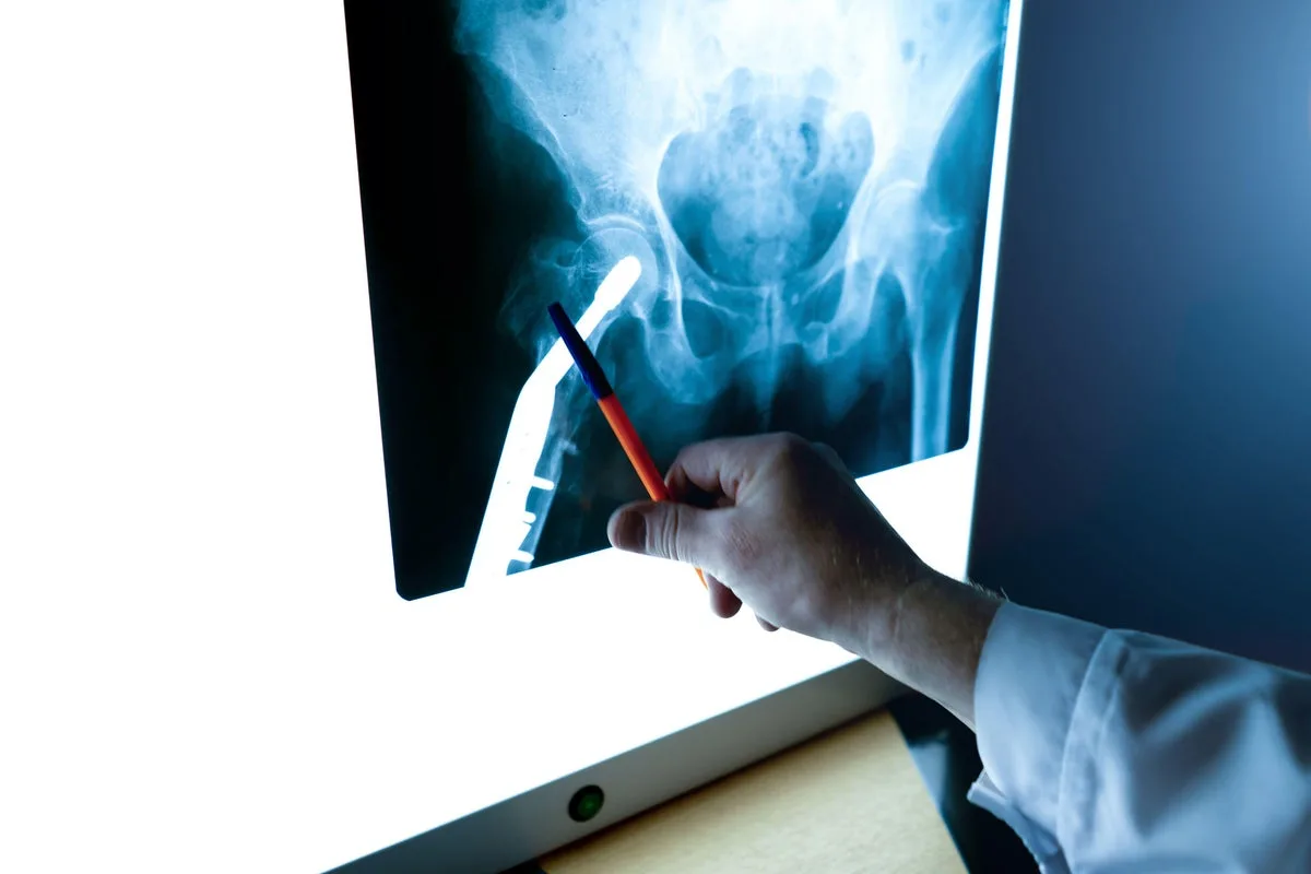 Frostrup Urges Streeting to End Osteoporosis Clinic Delays