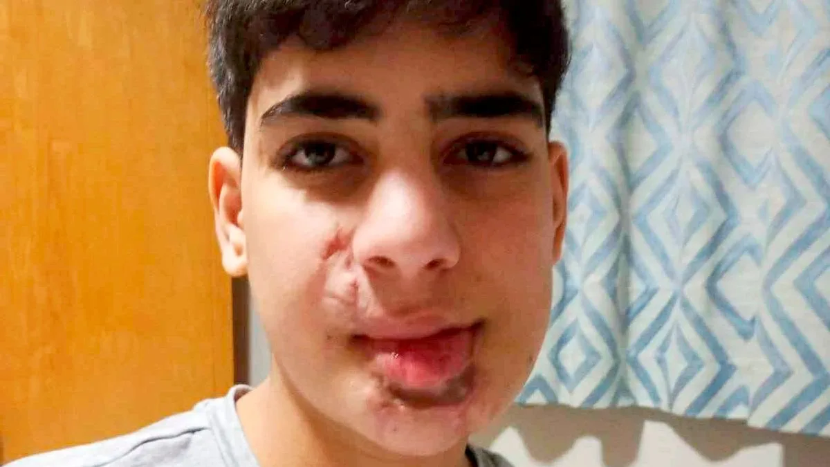 Gaza Teen Smiles Again After NHS Surgery