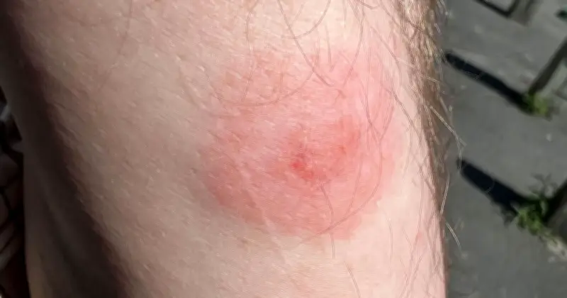GP Warns of Lyme Disease Surge in UK Summer: Full Symptom List