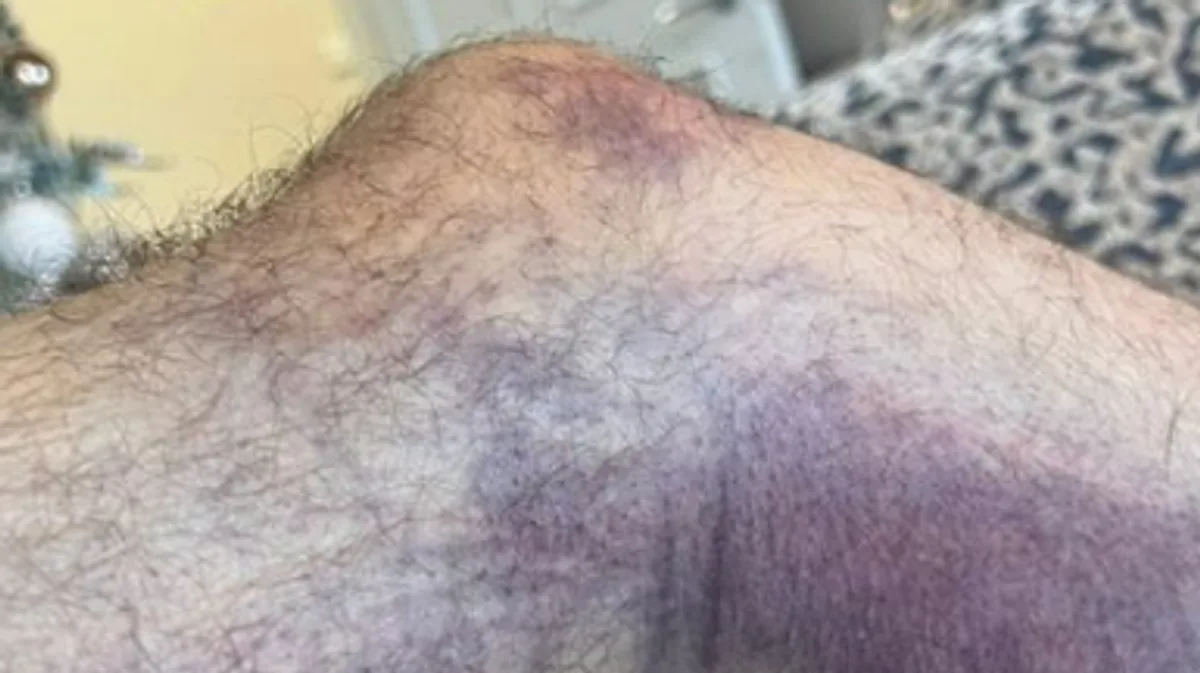 Hollyoaks Star Gary Lucy Shows Horrific Leg Injury After Boxing Day Car Crash