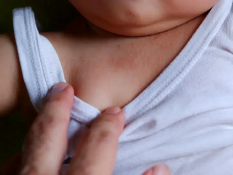 How to Spot and Treat Heat Rash in Babies: Symptoms and Care