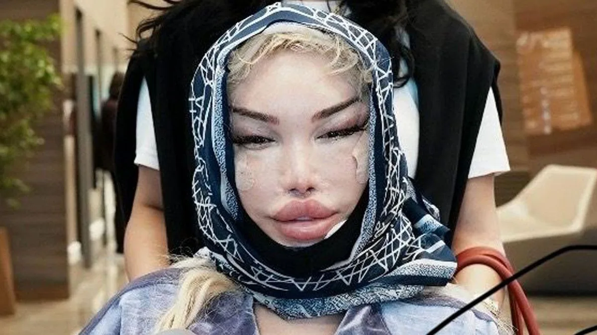 Jessica Alves Shows Off Bandaged Face After Sixth Facelift in Turkey