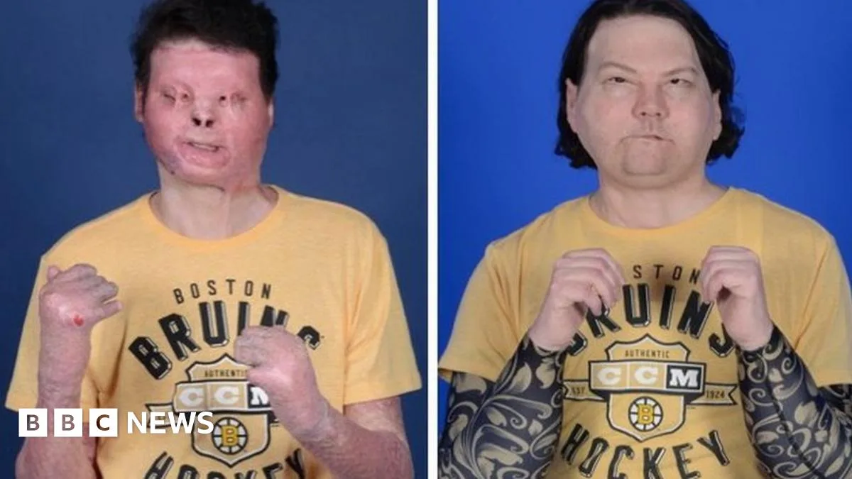 World's First Successful Face and Double Hand Transplant Performed in New York