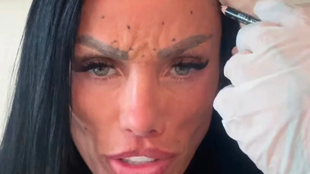 Katie Price Shows Forehead 'Humps' After Botox, Fans Worried
