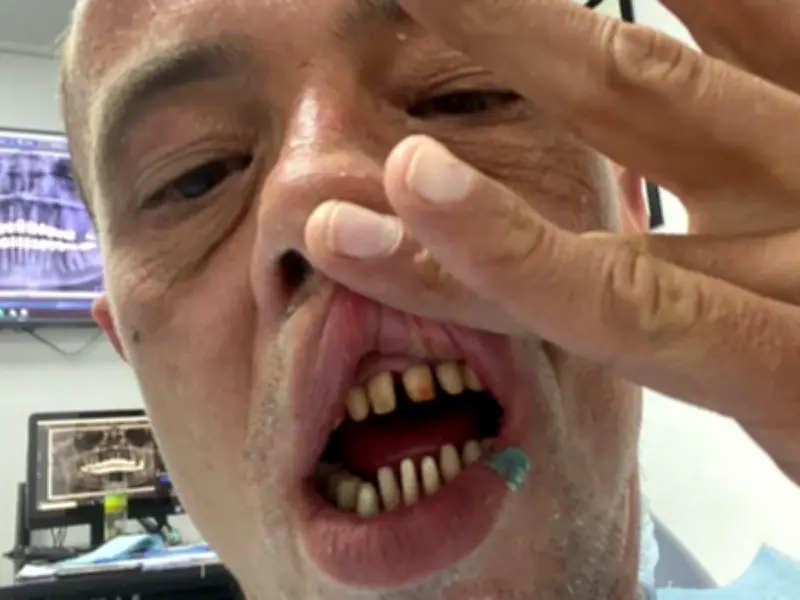 Man Faces £40,000 Bill as Turkey Teeth Start to Fall Out