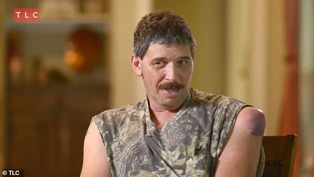 Man, 51, Has 'Crème Brûlée' Cyst Scooped Out with a Spoon on Dr Pimple Popper