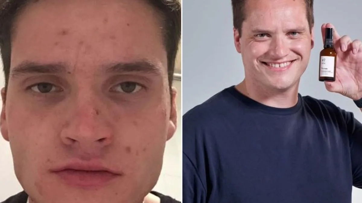 Grandmother's Secret Formula Clears Man's Decade-Long Blemishes in Four Days