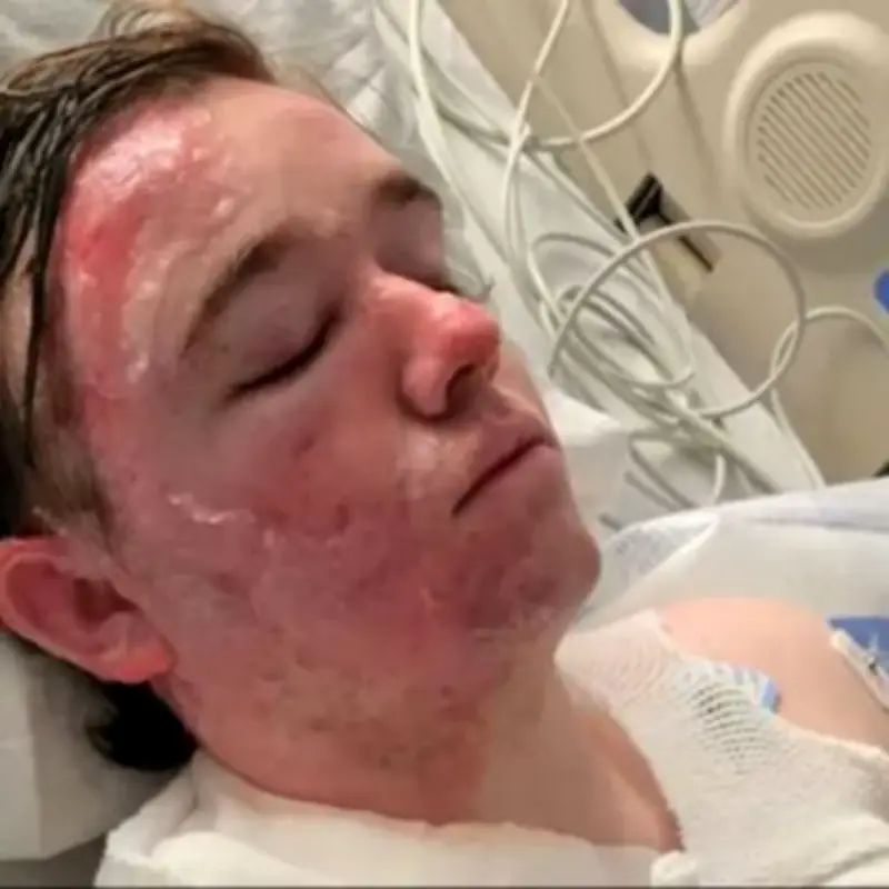 McDonald's Employee Severely Burned After Colleague Throws Hot Oil on Him