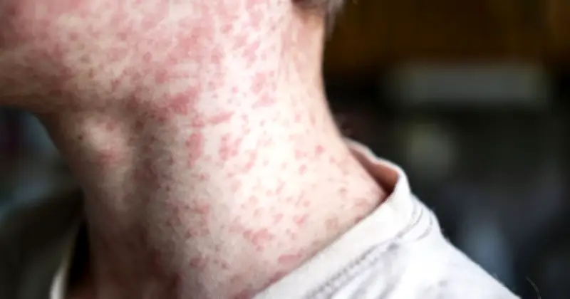 Measles Kills 2 Children in England: Expert Urgent Warning to Parents
