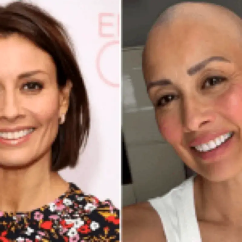 Melanie Sykes Goes Bald After Alopecia Diagnosis, Shares Empowering New Look