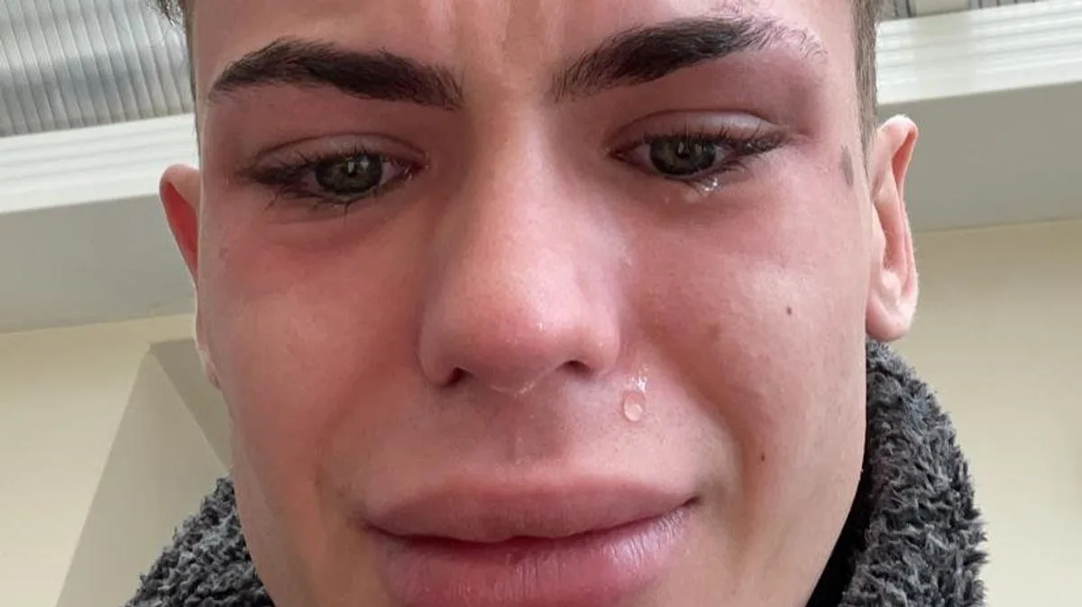 Model Warns of 'Turkey Teeth' Nightmare After £3k Veneers Leave Him Looking Like 'Shark in Horror Movie'