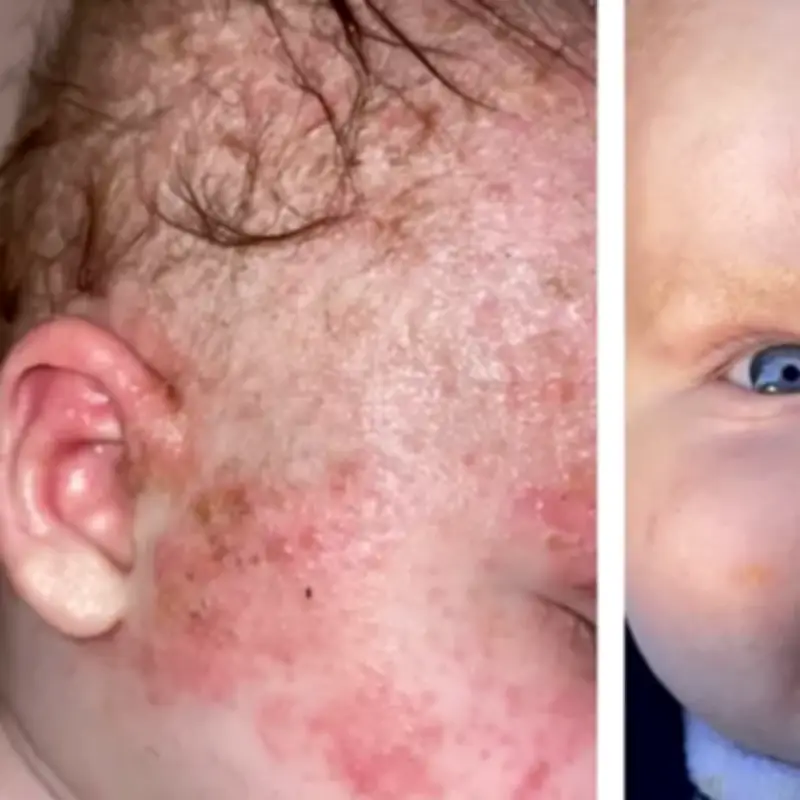 Mum 'astonished' by £2 balm that cleared baby's eczema in days