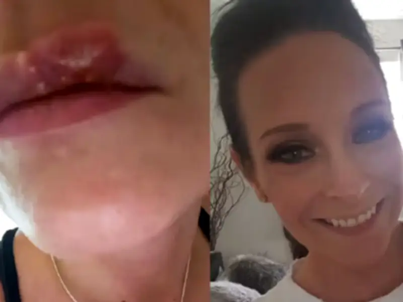 Mum Says Daughter 'Hasn't Had a Single Cold Sore' Since Using £9 'Miracle' Balm