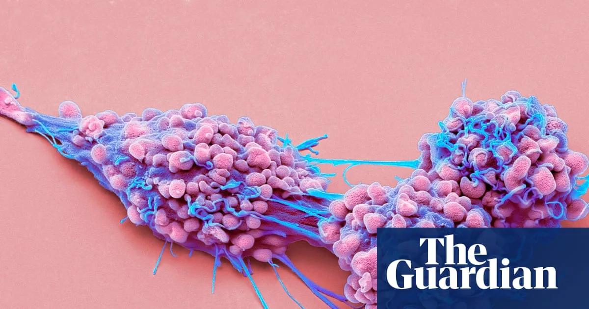 NHS England Approves First New Ovarian Cancer Drug in 20 Years