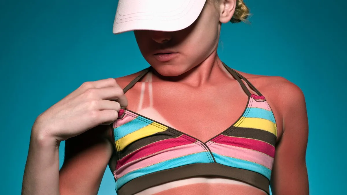 NHS Issues Sunburn Advice Following UK Heatwave
