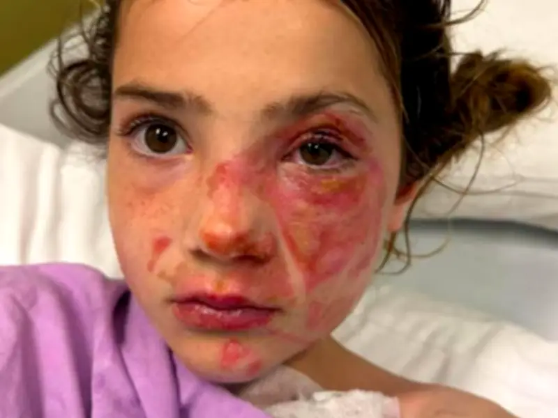 Parents Warned After Toy Leaves Children Hospitalised with Burns