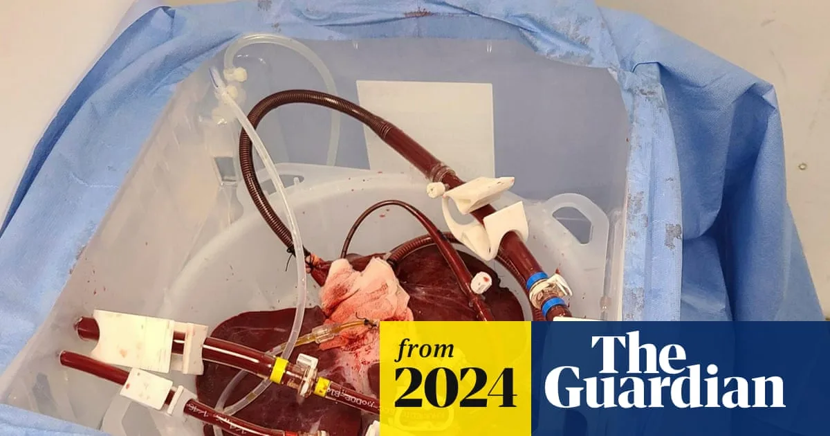 Pig Liver Successfully Filters Human Blood in External Transplant Trial