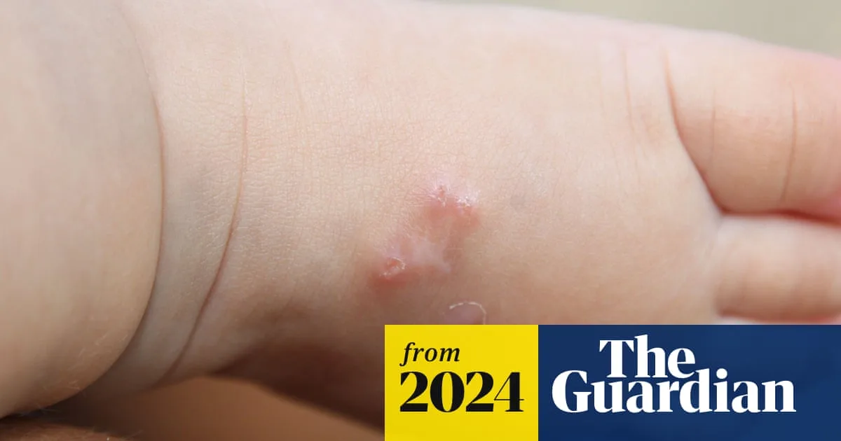 Scabies Surge In UK Misdiagnosed And Hard To Treat