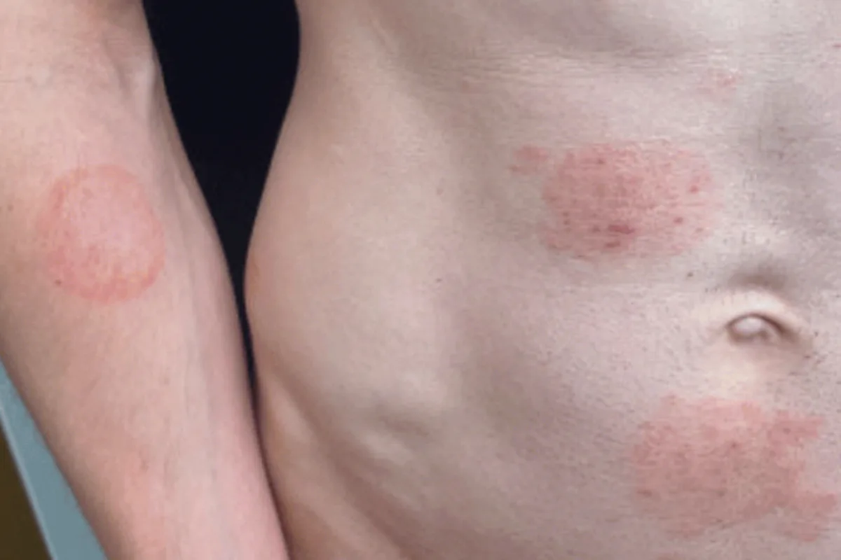 Minnesota Reports Largest US Outbreak of Sexually Transmitted Ringworm