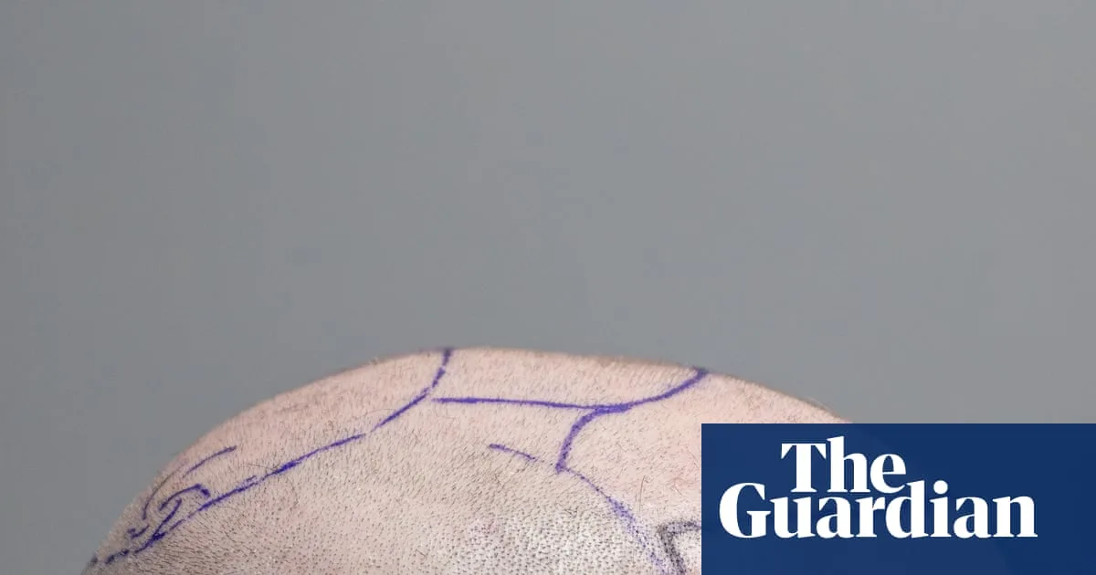 Social Media Fuels Turkey's Hair Transplant Boom for Young Men