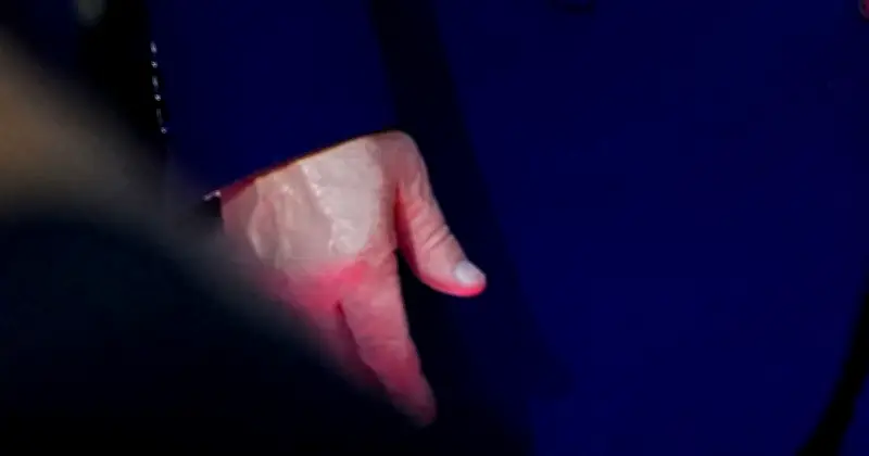 Trump's Discolored Hand Sparks Health Concerns at UFC Event