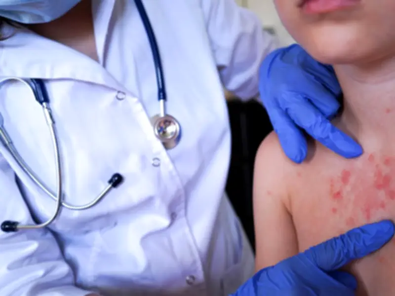 Two Children Die as Measles Spreads Across UK, UKHSA Confirms