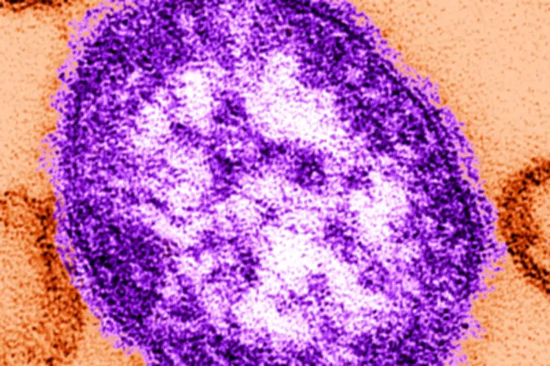 Two Children Die from Measles in England as Cases Rise in London