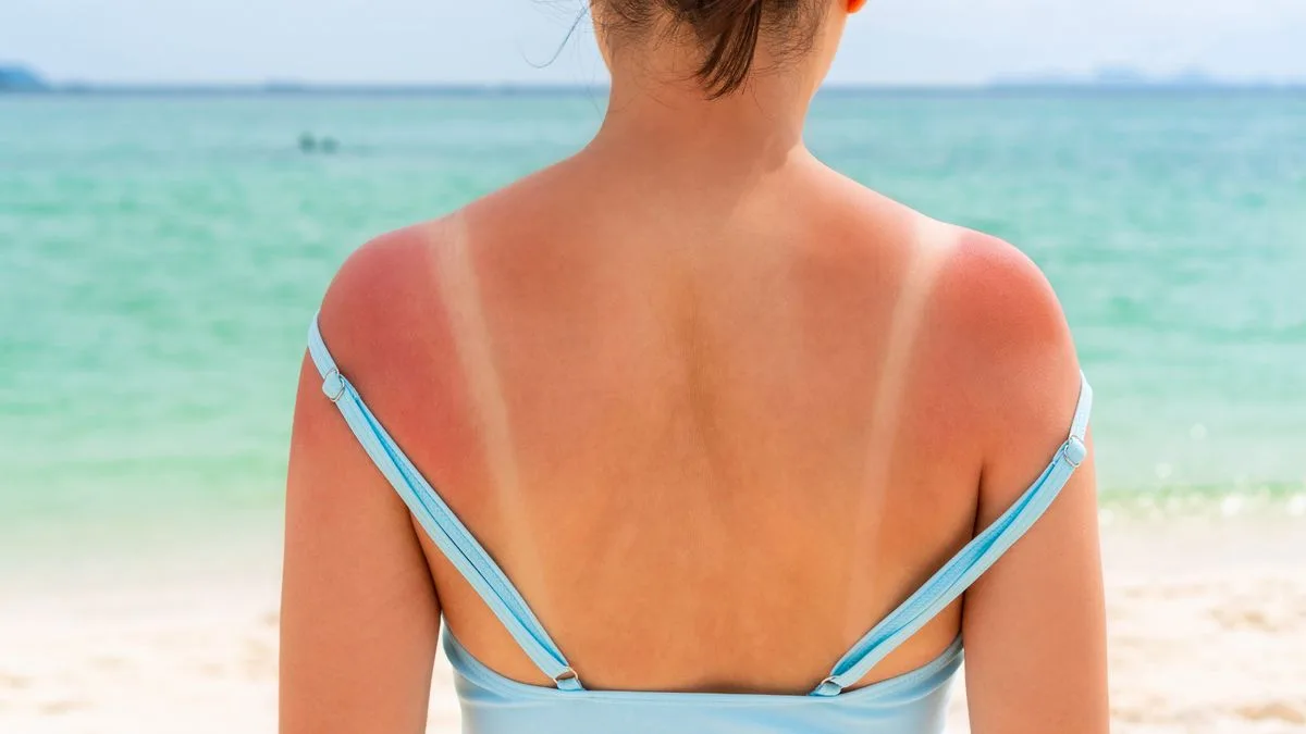 Skin cancer cases hit record high in UK as heatwave looms