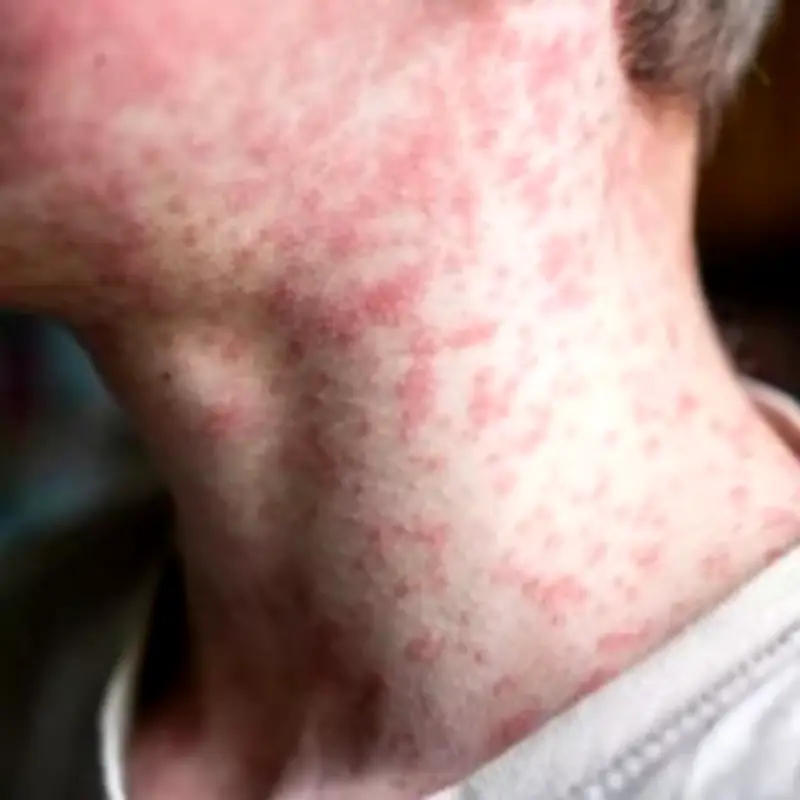 UK Measles Update: Urgent Warning to Parents as Over 100 New Cases Confirmed
