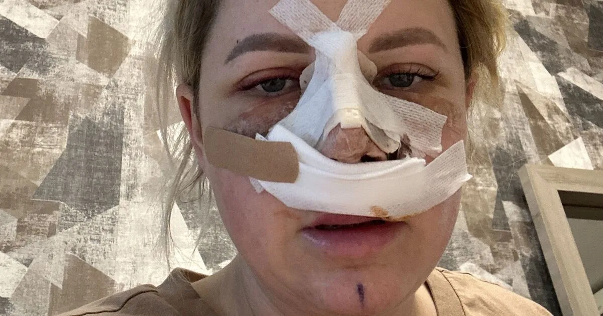 Mum Warns Against Turkish Nose Jobs After Botched Surgery Leaves Her Unable to Breathe